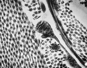 M, 48y. | Fabry disease - cornea M, 48y. | Fabry disease - cornea